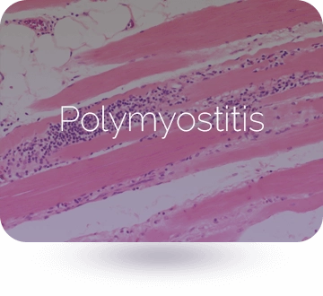 polymyositis